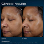 Skin rejuvenation results showing improved skin texture and glow after 12 weeks.