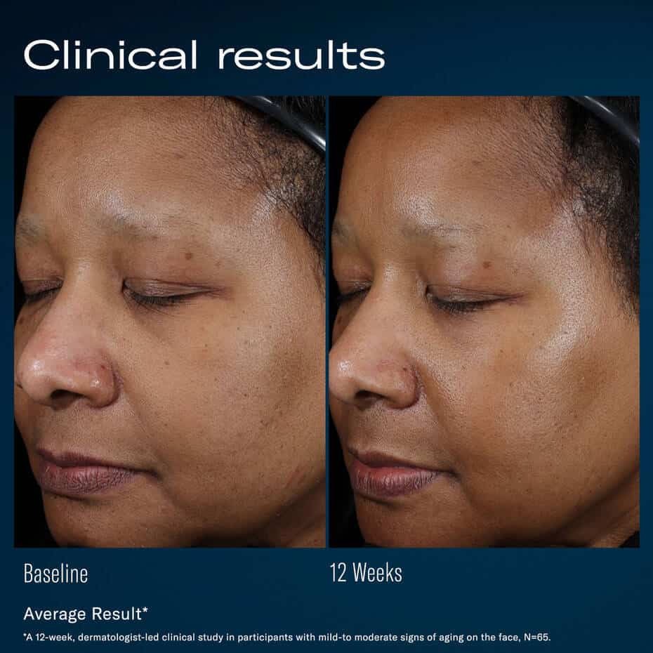 Skin rejuvenation results showing improved skin texture and glow after 12 weeks.