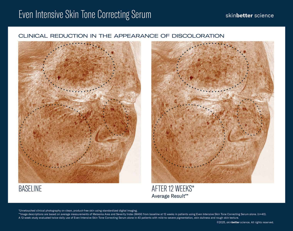 Before and after 12 weeks of skin tone correction with serum.