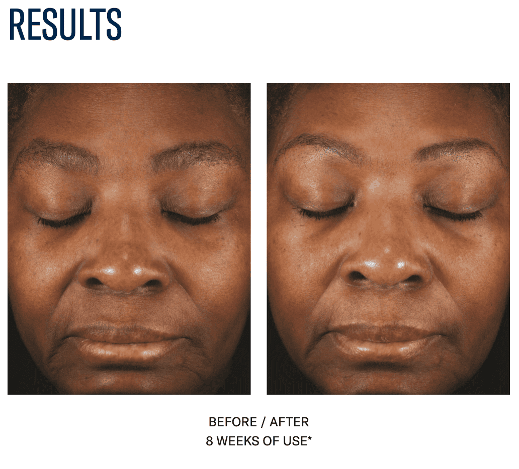 Facial skin improvement after 8 weeks of treatment at SF Wellness.