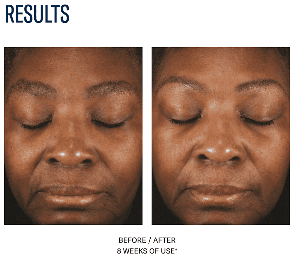 Facial skin improvement after 8 weeks of treatment at SF Wellness.
