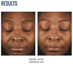 Facial skin improvement after 8 weeks of treatment at SF Wellness.