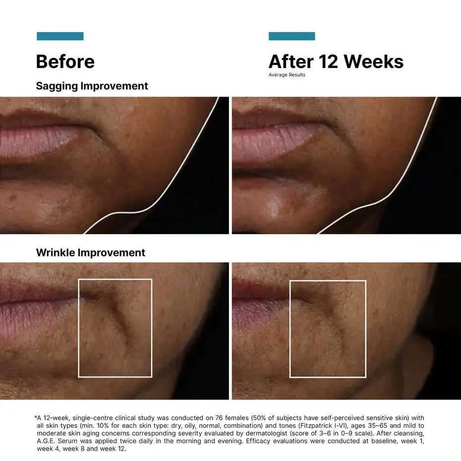 Before and after images showing skin improvement after 12 weeks of treatment.