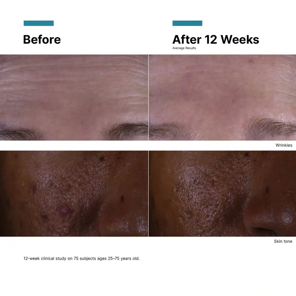Before and after skin improvement with SkinCeuticals C E Ferulic.