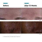 Before and after skin improvement with SkinCeuticals C E Ferulic.
