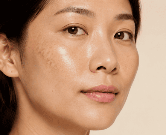 Uneven Skin Tone